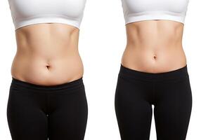 Before and after image of a woman's stomach before and after a tummy tuck photo