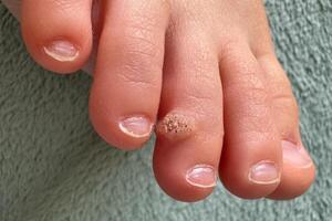 Close-up of a child's foot showing a wart on toe. The skin texture and growth are clearly visible, highlighting a common dermatological condition photo