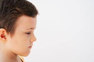 The face of a child infected with the Coxsackie virus. Spots, Blisters and a rash on the boy's face. photo