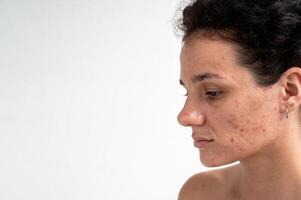Close-up skin texture with red pimples, irritation and clogged pores, which indicates dermatological problems with skin care. Hormonal acne and spots on the face. photo