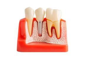 Dental implant, artificial tooth roots into jaw isolated on white background with clipping path. photo