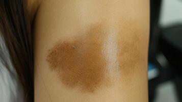 Close-up view of a brown skin discoloration on an arm. photo