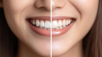 A woman with white teeth before and after photo