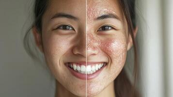 Before and after comparison of skin condition on a person's face. photo
