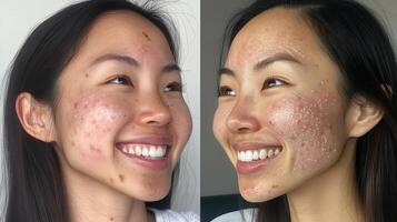 Before and after view of skin blemishes improvement. photo
