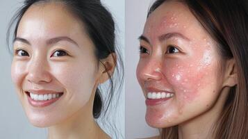 Before and after image of facial skin treatment. photo