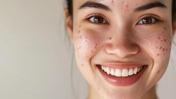 Close-up portrait of a person with acne scars. photo