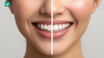 A woman's smile before and after teeth whitening photo