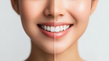 Comparison of teeth whitening before and after treatment. photo