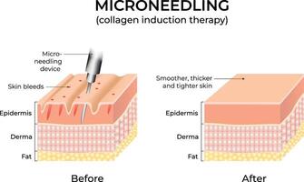 Microneedling procedure illustration showing skin layers before and after treatment Design vector