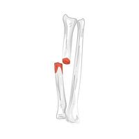 Illustration of fracture vector