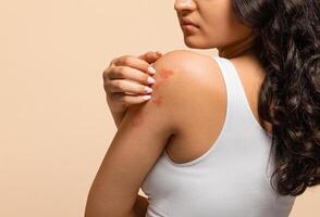 Unhappy young woman scratching her irritated skin on arm, annoyed indian female wearing white top suffering eczema or dermatitis, having itching rash on body, standing on beige studio background photo