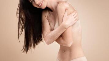 Love Your Body. Portrait Of Skinny Young Lady With Vitiligo Skin Disorder Posing In Underwear On Beige Background In Studio, Cropped Image Of Positive Woman With Skin Depigmentation, Free Space photo