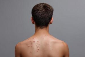 Skin condition effects visible on the back of a young male subject in a neutral setting photo