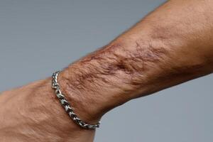 Person's forearm showing prominent scars and skin texture under studio lighting photo