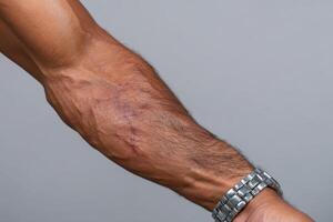 Arm with visible veins and a scar in a close-up shot during a health-focused photo session