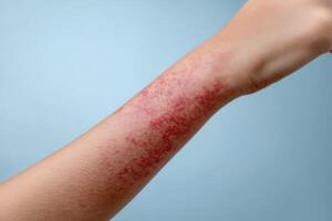 Skin condition displaying redness and irritation on a person's arm against a light background photo