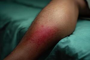 Red marks on the leg after an injury in a medical facility at daytime photo