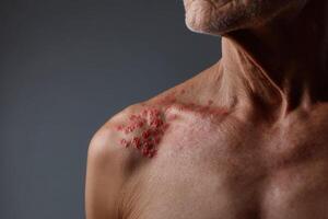 Skin condition affects older man's shoulder with red spots in close-up view during indoor session photo