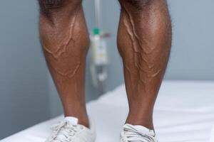 Varicose veins visibly present on legs in clinical setting during examination photo
