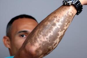 Skin condition visible on man's arm shows unique patterns and textures indoors photo