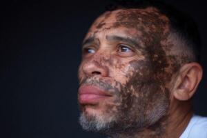Man with unique skin patterns gazes into the distance in thoughtful contemplation photo