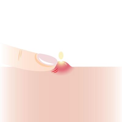Infographic of squeeze inflammatory acne with one finger on skin illustration isolated on white background. Pustule on skin, squeezing, popping pimple. Skin care and beauty concept.