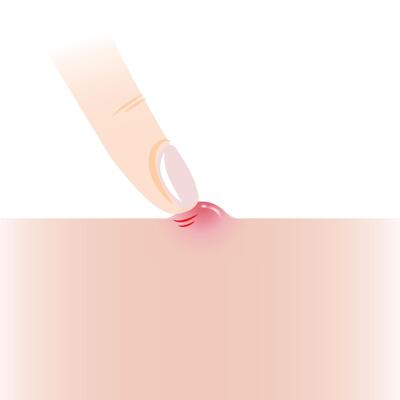 Infographic of pick at pimple with finger on skin illustration isolated on white background. Papule, inflammatory acne on skin, squeeze, pop pimple. Skin care and beauty concept.
