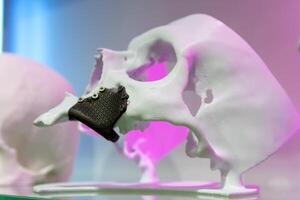 Layout of the human skull with implants made using 3D printing technology. Medicine photo