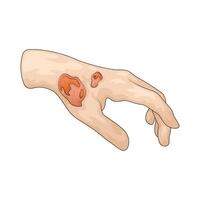 wound on hand vector