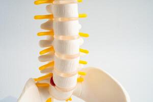 Lumbar spine displaced herniated disc fragment, spinal nerve and bone. Model photo