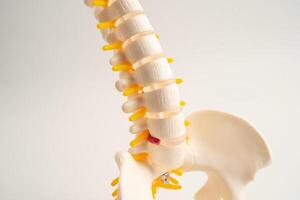 Lumbar spine displaced herniated disc fragment, spinal nerve and bone. Model for treatment medical in the orthopedic photo