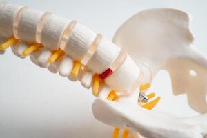 Lumbar spine displaced herniated disc fragment, spinal nerve and bone. Model for treatment medical in the photo