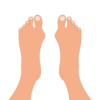 humano pies con deformidades de grande dedo del pie articulación. parte superior ver de desnudo pies con hallux valgo deformación vector