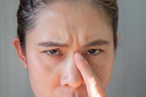 Portrait of unhappy Asian woman pointing to an acne occur between her eyebrows. Allergies, irritants, genetic makeup, etc can cause skin conditions. photo