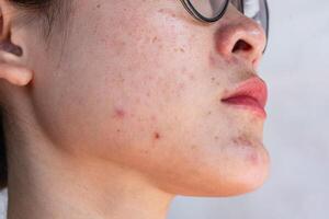 Cropped shot view of Asian woman having skin problem such as acne, scar, wrinkled occur on her face. Allergies, irritants, genetic makeup, etc can cause skin conditions. photo
