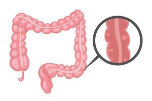 Intestinal polyps forming inside large intestine forming a tumor vector