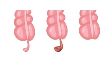 Appendicitis inflammation developing in three stages, from normal appendix to infected appendix vector