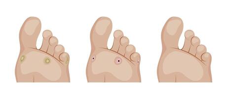 Callus and corn removal process showing different stages of healing vector