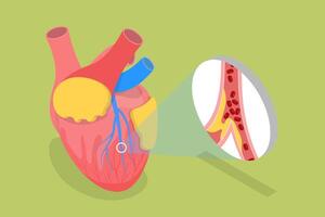 3D Isometric Flat Conceptual Illustration of Myocardial Infarction, Heart Attack vector