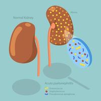3D Isometric Flat Conceptual Illustration of Acute Pyelonephritis, Urinary Tract Infection vector