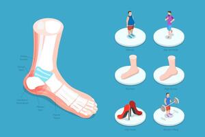 3D Isometric Flat Conceptual Illustration of Heel Spur, Calcaneal Bone Condition vector