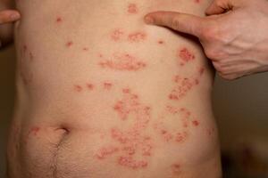 Skin condition causes red, itchy, and scaly patches typical of psoriasis affecting the torso area photo