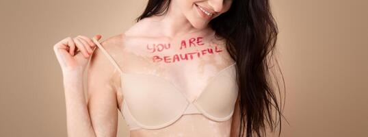 Self-Acceptance. Portrait Of Proud Woman With Vitiligo Skin Having Written You Are Beautiful Inscription On Chest, Cheerful Body Positive Lady Posing In Bra Over Beige Studio Background, Copy Space photo