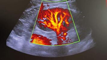 Color Doppler Ultrasound Scan Showing Blood Flow Activity, Vascular Pattern Highlighted In Red video