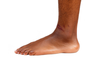 Bruised shin showing skin lesion on transparent background png