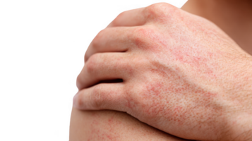 Man suffering from dermatitis is scratching his shoulder with red rash on transparent background png