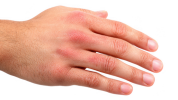 Man showing red rash on hand on transparent background png