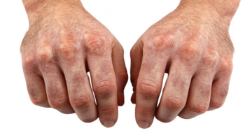 Two hands showing hyperpigmentation on transparent background png
