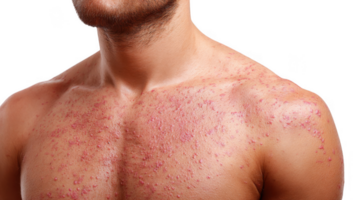Man showing measles rash on chest and shoulder on transparent background png